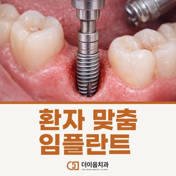 환자맞춤 임플란트